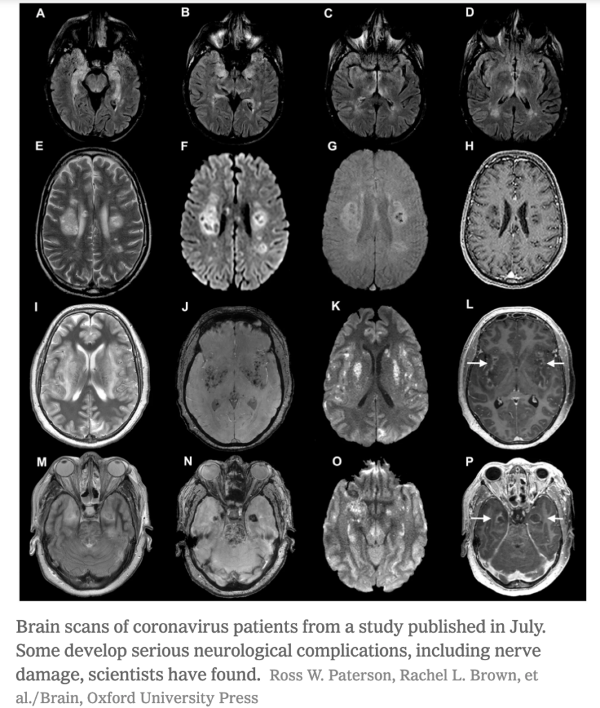 Brain scans from COVID-19 patients from a study published in July indicate that some individuals develop serious neurological complications, including nerve damage